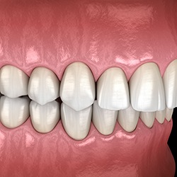 Illustration of an overbite