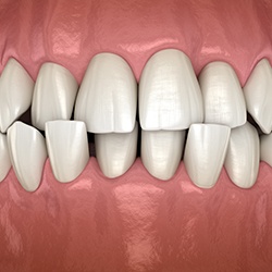 Illustration of a crossbite