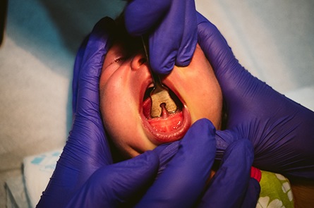 Frenectomy being performed