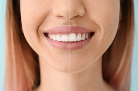 Woman before and after gum recontouring