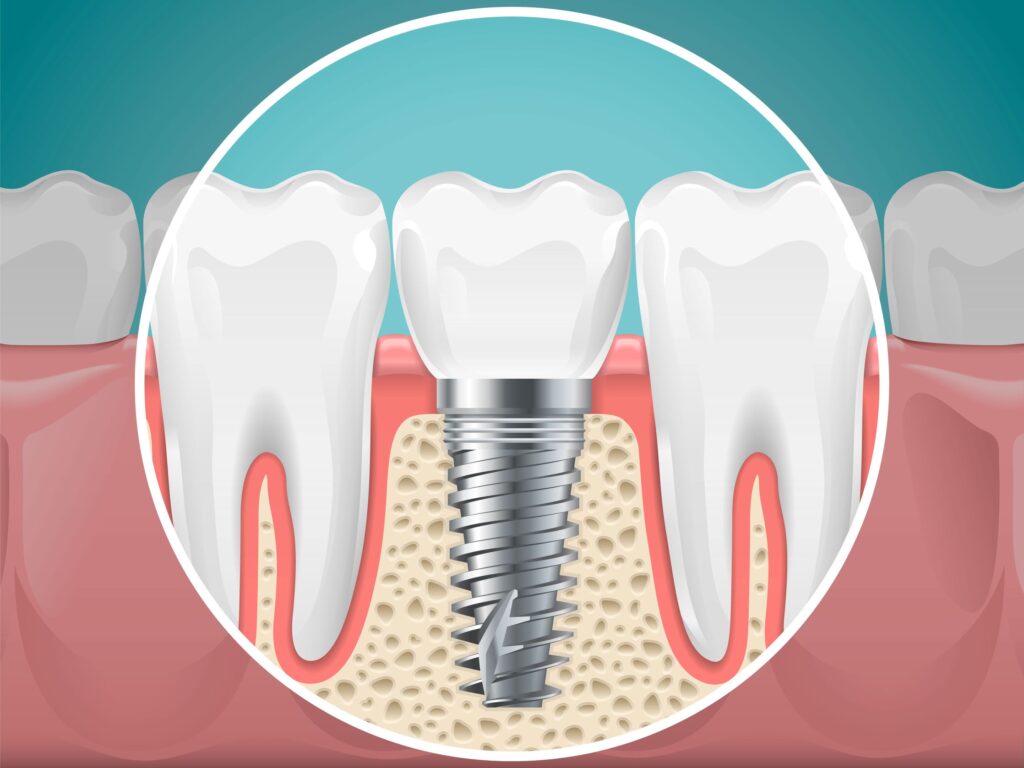 Illustration showing dental implant nestled between two teeth with teal background